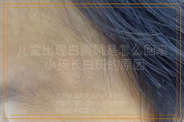 儿童出现白癜风是怎么回事 小孩长白斑的原因