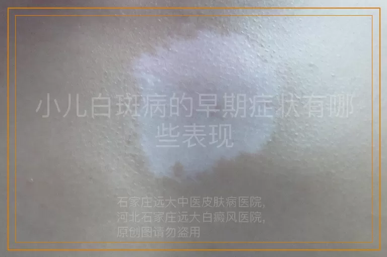 小儿白斑病的早期症状有哪些表现