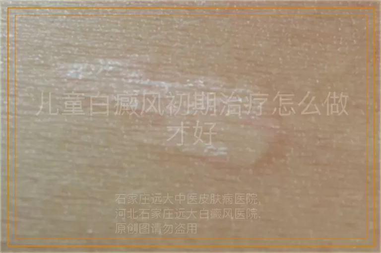 儿童白癜风初期治疗怎么做才好