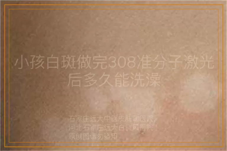 小孩白斑做完308准分子激光后多久能洗澡