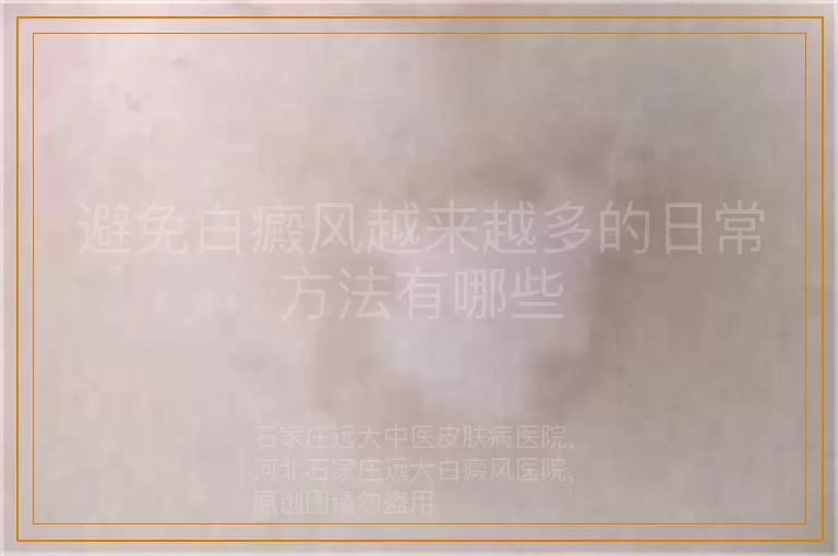 避免白癜风越来越多的日常方法有哪些