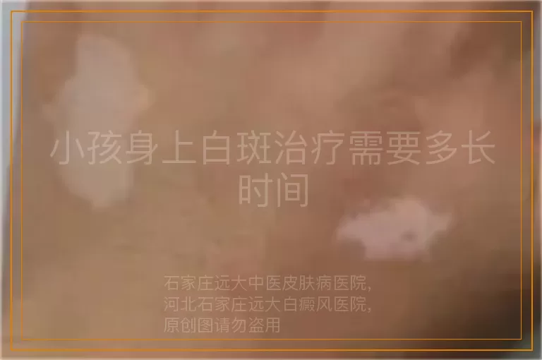 小孩身上白斑治疗需要多长时间