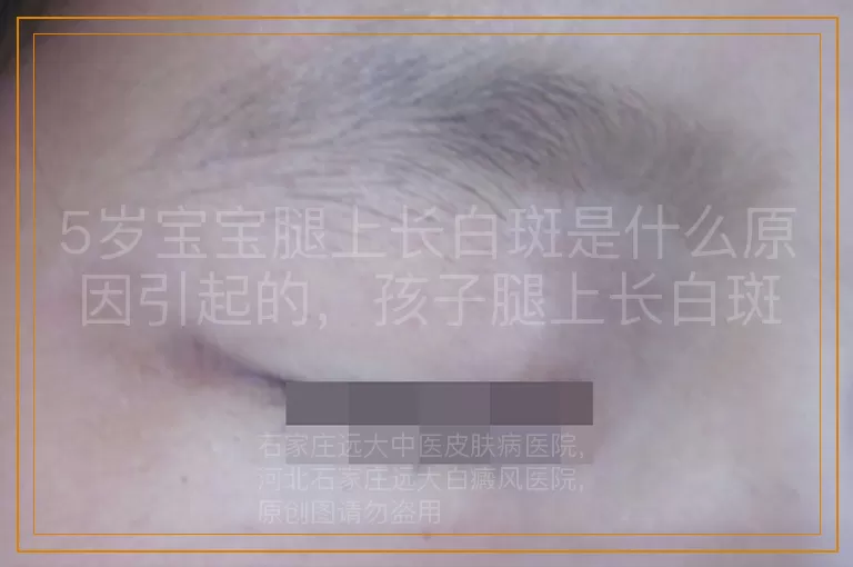 5岁宝宝腿上长白斑是什么原因引起的，孩子腿上长白斑会不会是白癜风呢，5岁宝宝腿上有白斑怎么判断是不是白癜风