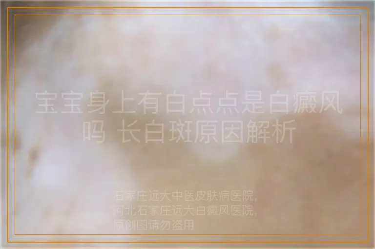 宝宝身上有白点点是白癜风吗 长白斑原因解析