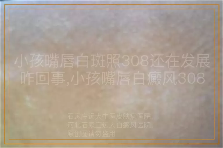 小孩嘴唇白斑照308还在发展咋回事,小孩嘴唇白癜风308后仍扩散原因,儿童嘴唇白斑308治疗中发展解析