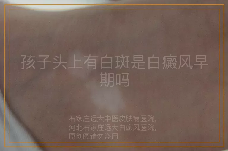 孩子头上有白斑是白癜风早期吗