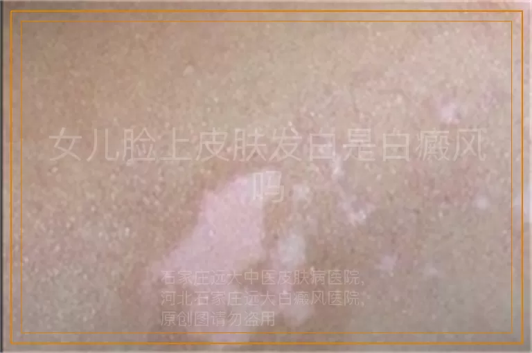 女儿脸上皮肤发白是白癜风吗