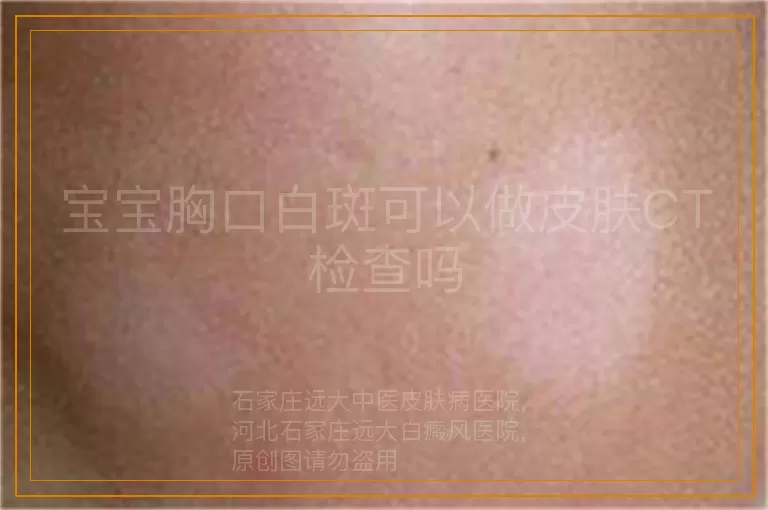 宝宝胸口白斑可以做皮肤CT检查吗