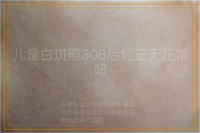 儿童白斑照308后红三天正常吗