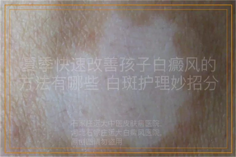夏季快速改善孩子白癜风的方法有哪些 白斑护理妙招分享