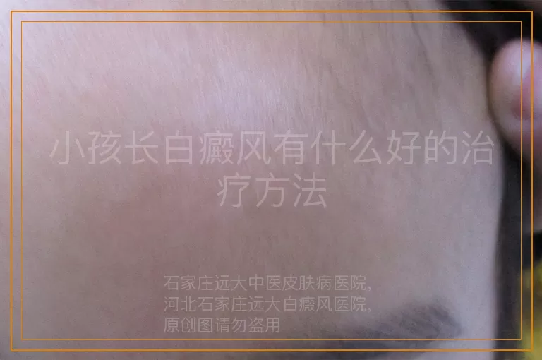 小孩长白癜风有什么好的治疗方法