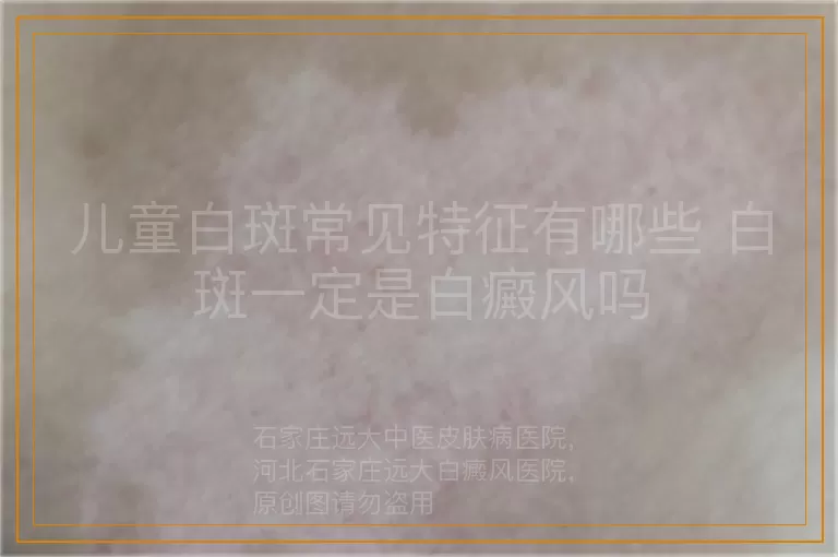 儿童白斑常见特征有哪些 白斑一定是白癜风吗