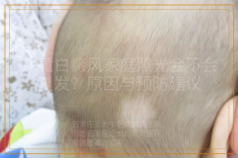 儿童白癜风家庭照光会不会复发？原因与预防建议