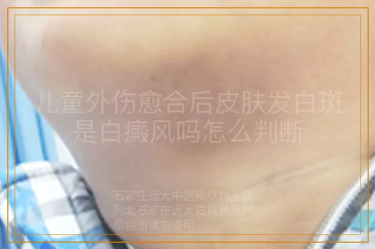 儿童外伤愈合后皮肤发白斑是白癜风吗怎么判断