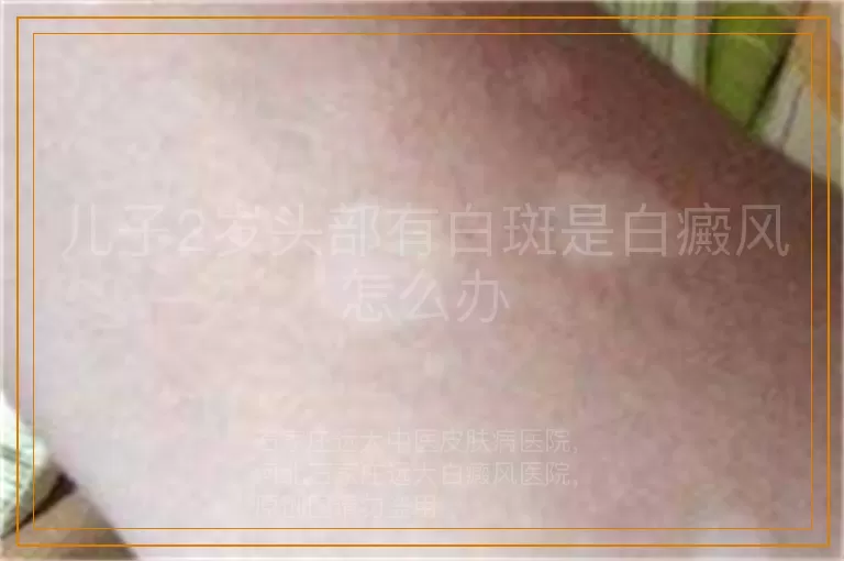 儿子2岁头部有白斑是白癜风怎么办