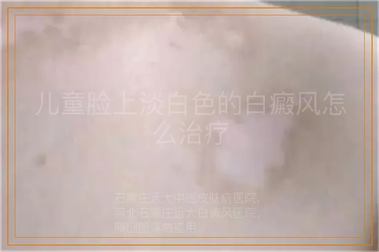 儿童脸上淡白色的白癜风怎么治疗
