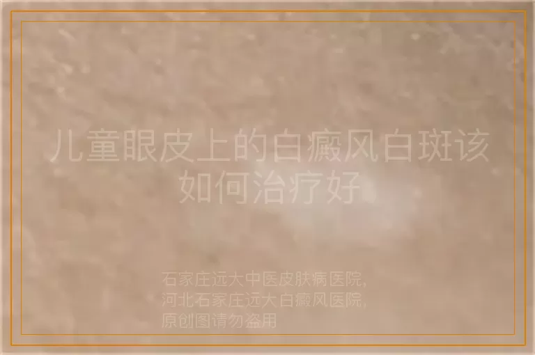 儿童眼皮上的白癜风白斑该如何治疗好