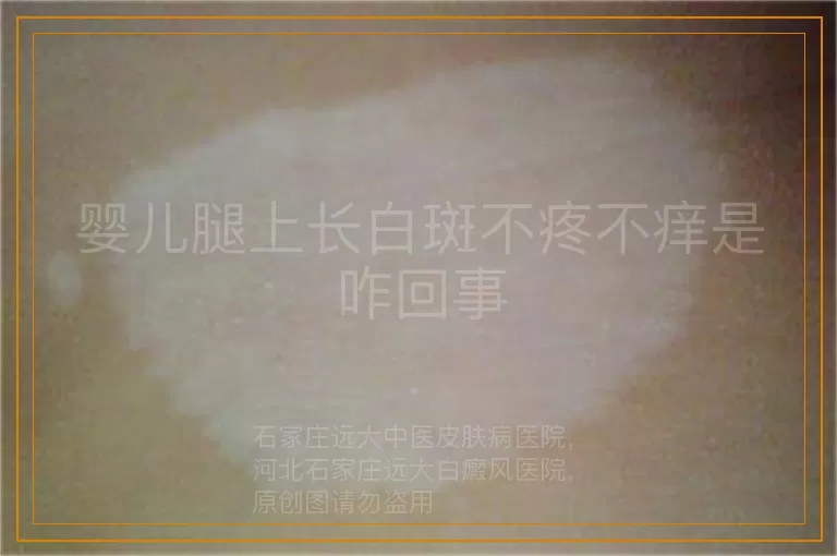 婴儿腿上长白斑不疼不痒是咋回事