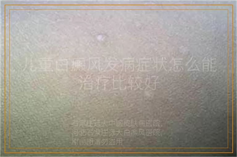儿童白癜风发病症状怎么能治疗比较好