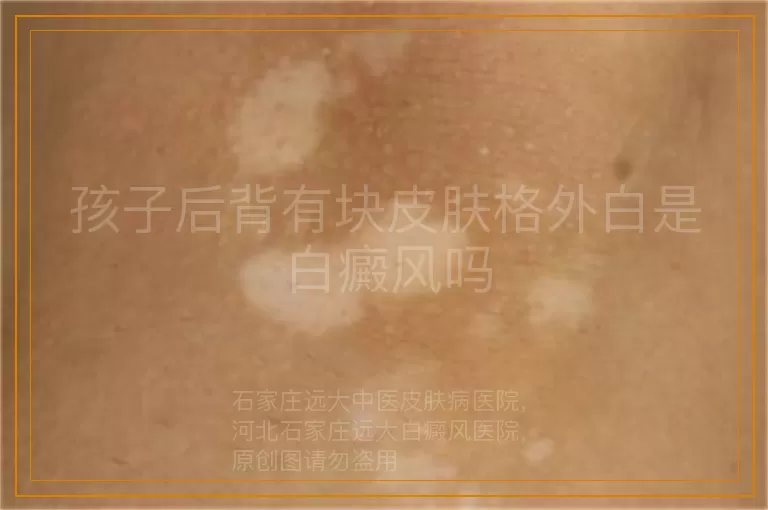 孩子后背有块皮肤格外白是白癜风吗