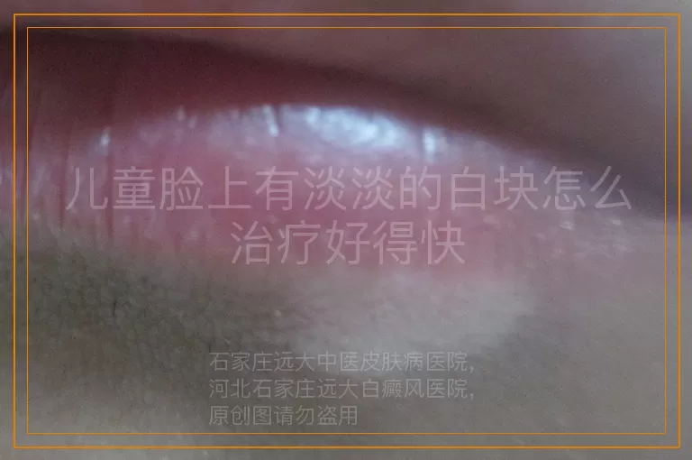 儿童脸上有淡淡的白块怎么治疗好得快