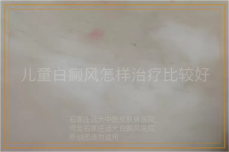 儿童白癜风怎样治疗比较好