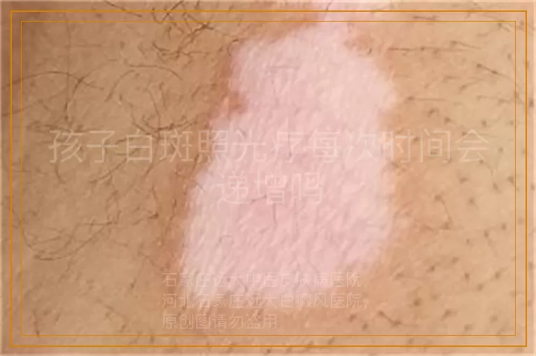 孩子白斑照光疗每次时间会递增吗
