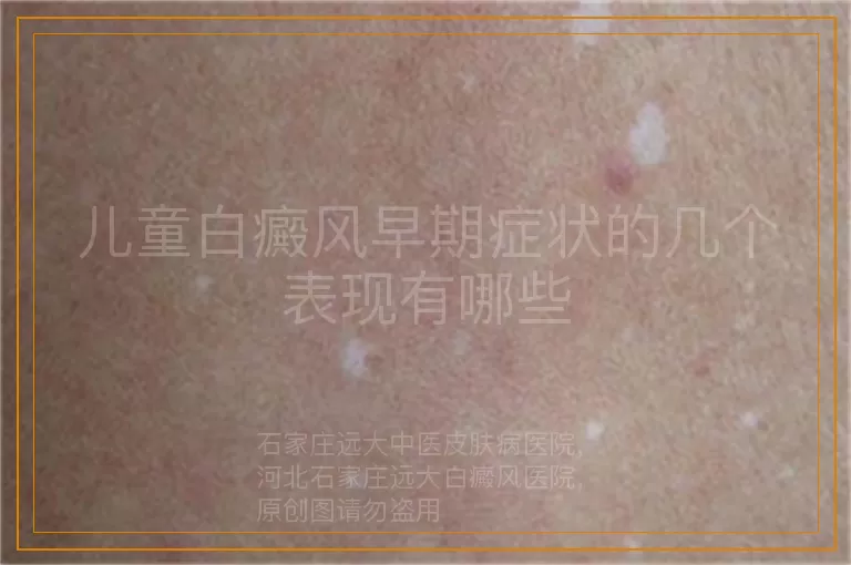 儿童白癜风早期症状的几个表现有哪些