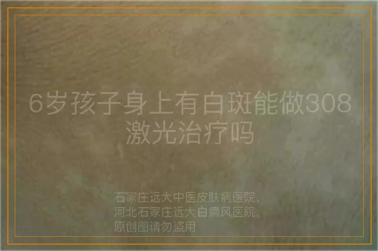 6岁孩子身上有白斑能做308激光治疗吗