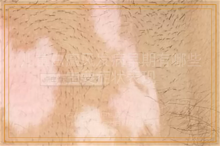 儿童白癜风发病早期有哪些主要症状表现