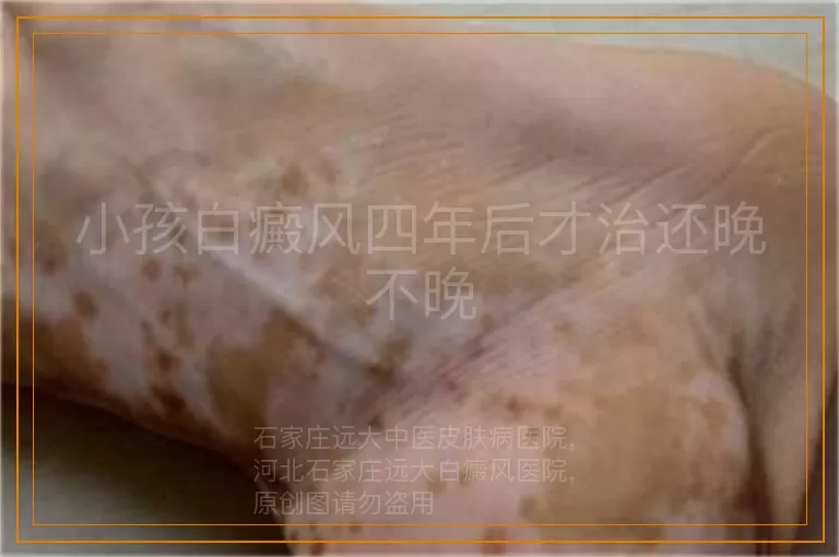 小孩白癜风四年后才治还晚不晚
