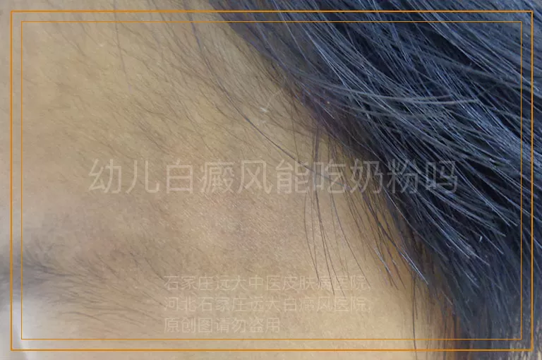 幼儿白癜风能吃奶粉吗
