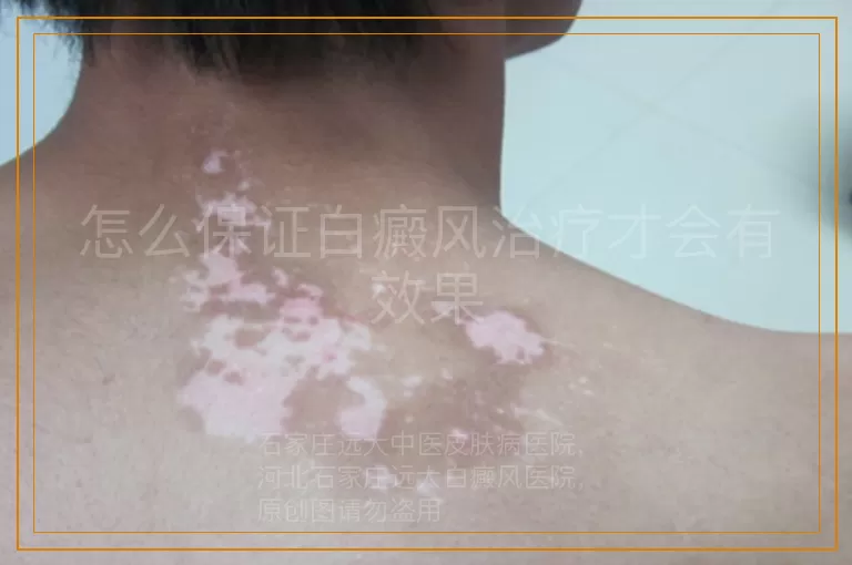 怎么保证白癜风治疗才会有效果