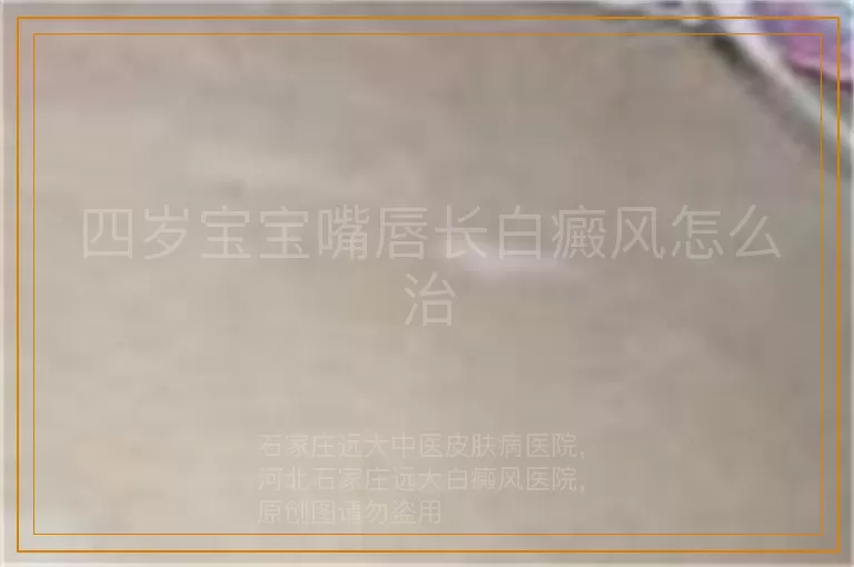 四岁宝宝嘴唇长白癜风怎么治