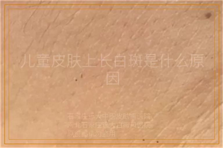 儿童皮肤上长白斑是什么原因