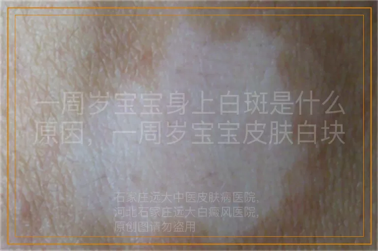 一周岁宝宝身上白斑是什么原因，一周岁宝宝皮肤白块是白癜风吗，宝宝身上有一小块白斑怎么回事