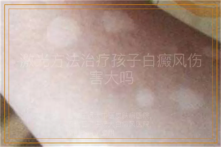 激光方法治疗孩子白癜风伤害大吗