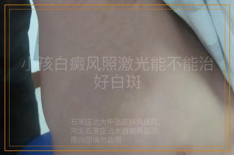 小孩白癜风照激光能不能治好白斑
