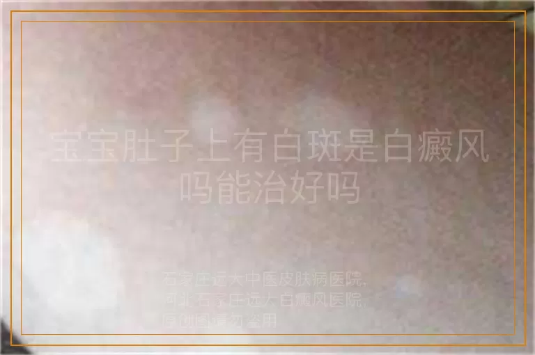 宝宝肚子上有白斑是白癜风吗能治好吗