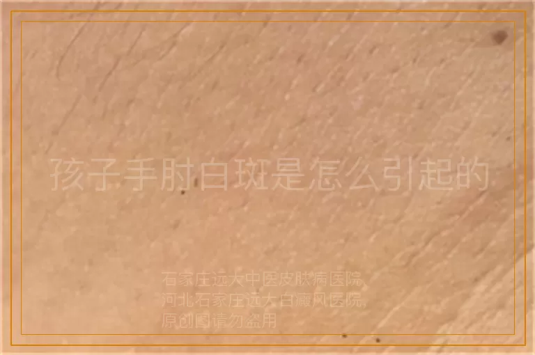 孩子手肘白斑是怎么引起的