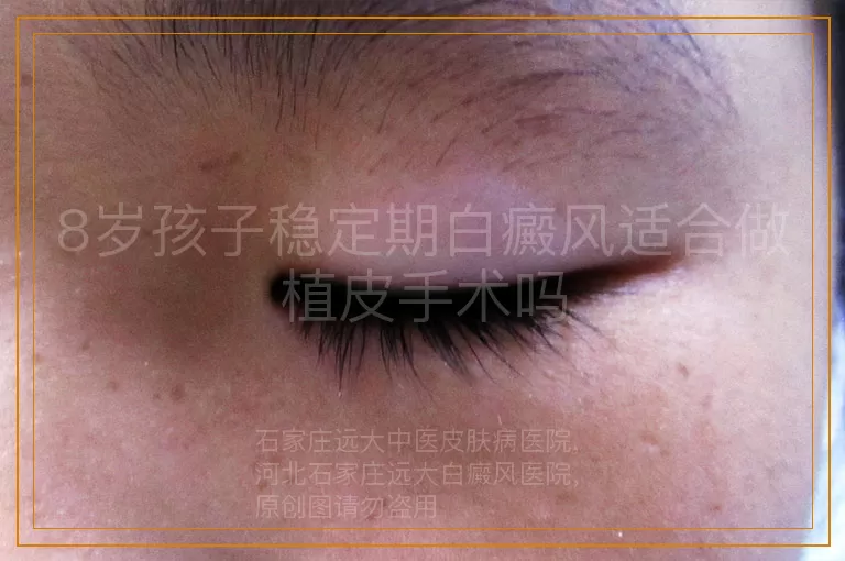 8岁孩子稳定期白癜风适合做植皮手术吗