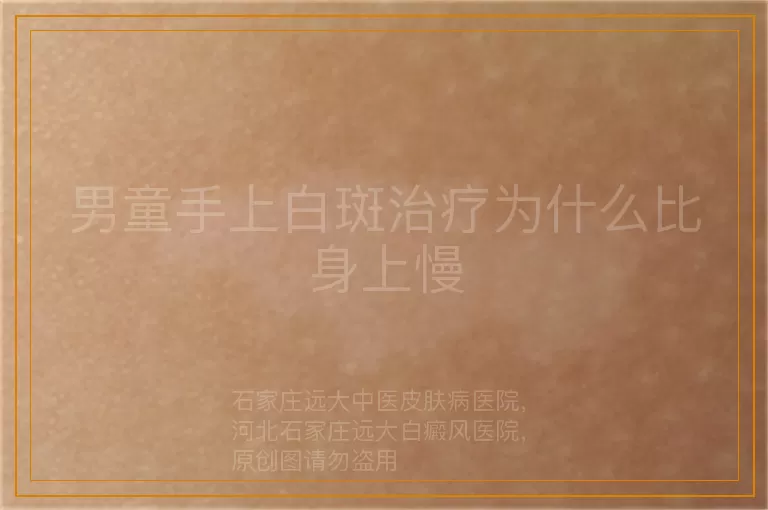 男童手上白斑治疗为什么比身上慢