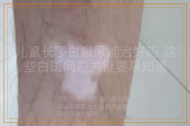 儿童长了白癜风能治好吗 这些白斑问题关键要早知道