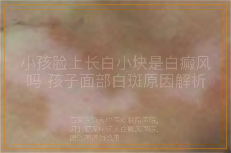 小孩脸上长白小块是白癜风吗 孩子面部白斑原因解析