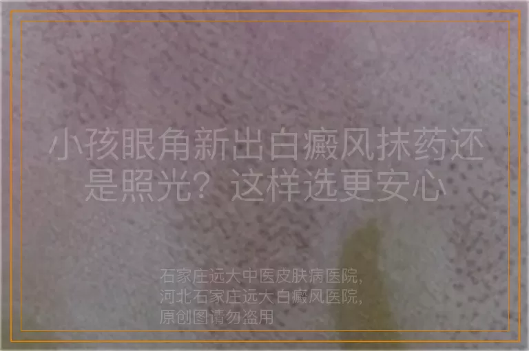 小孩眼角新出白癜风抹药还是照光？这样选更安心
