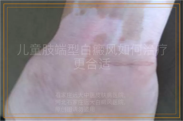儿童肢端型白癜风如何治疗更合适