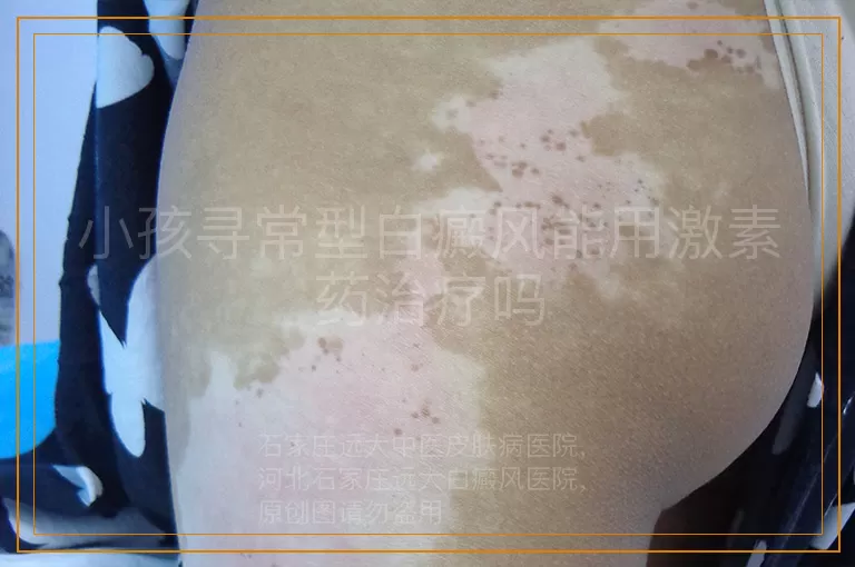 小孩寻常型白癜风能用激素药治疗吗