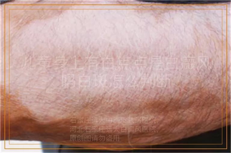 儿童身上有白点点是白癜风吗白斑怎么判断