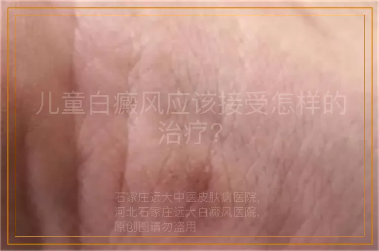 儿童白癜风应该接受怎样的治疗?