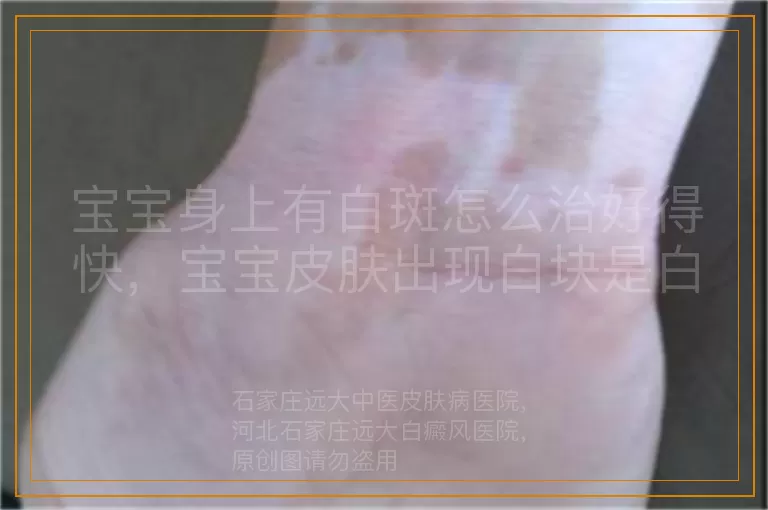 宝宝身上有白斑怎么治好得快，宝宝皮肤出现白块是白癜风咋办，小孩身上长白斑如何正确治疗